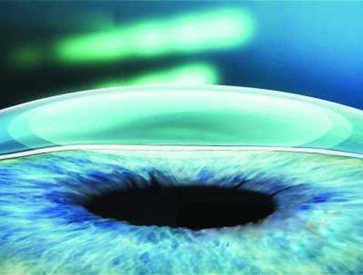 隐形眼镜令眼角膜变薄