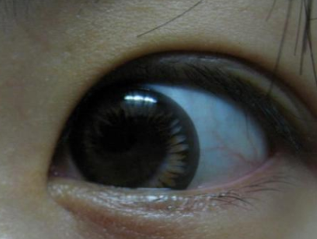 隐形眼镜滑片怎么办